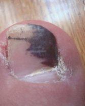 Nail Fungus Pictures - Nail Fungus Answers